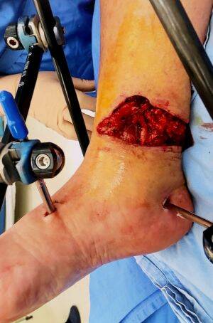 Sandra Hocking's superbug wound before it was treated. Photo: Wayne Taylor
